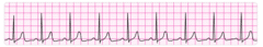 Administer epinephrine 1 mg.