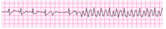 Course Ventricular Fibrillation