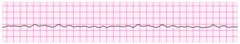 Fine ventricular fibrillation