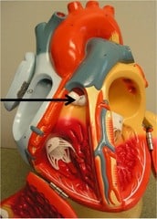 Pulmonary valve (semilunar valves; DUB)