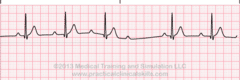 2nd degree heart block type 1 (Wenkebach)