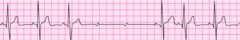 3˚ AV block