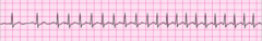 4. Repeat adenosine 12 mg IV .