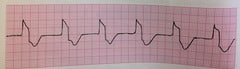 Accelerated Idioventricular Rhythm