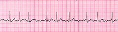 Atrial Fibrillation (A-Fib)