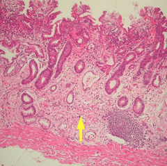 Intestinal metaplasia can be seen in pernicious anemia