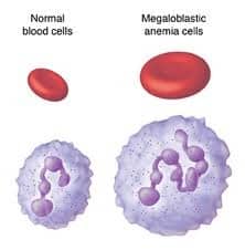 megaloblastic anemias