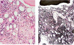 Myelofibrosis