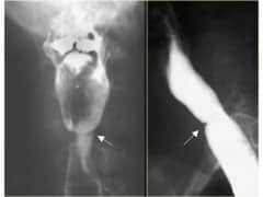 Plummer vinson syndrome