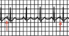 Premature Atrial Contraction