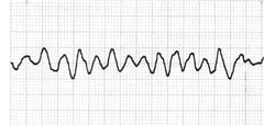 Ventricular fibrillation (V-fib)