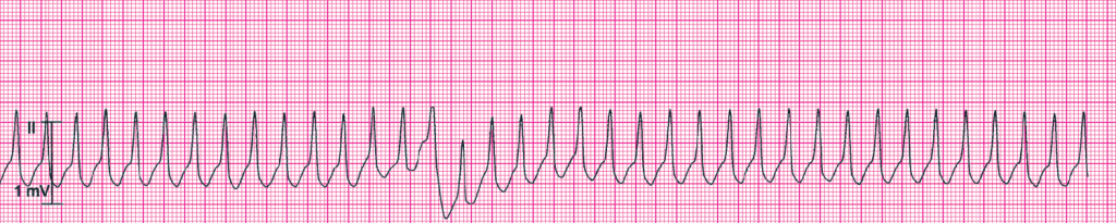 Clinical clue: heart rate 214/min