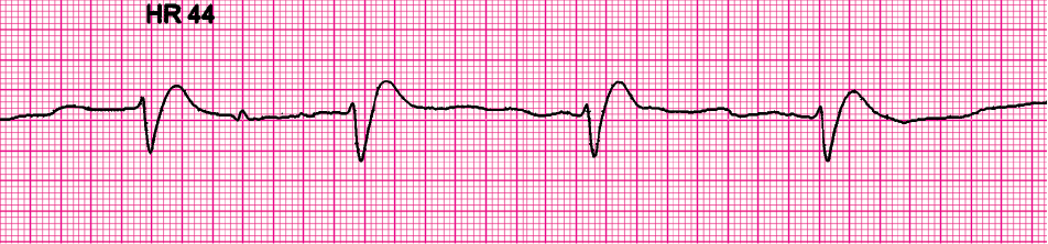 Clinical clues: heart rate 44/min; no detectable pulses