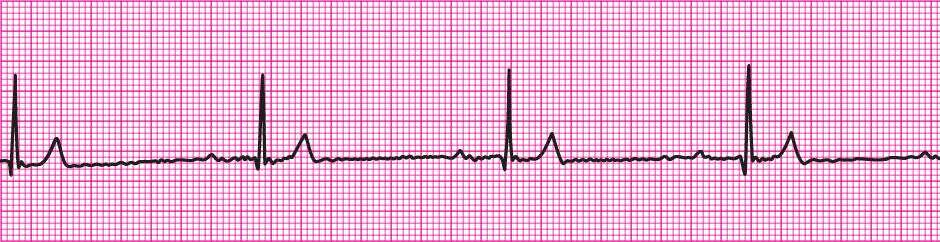 Clinical clues: age 7 years; heart rate 38/min