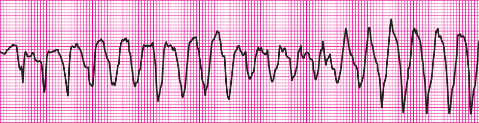 Clinical clues: heart rate 200/min; no detectable pulses