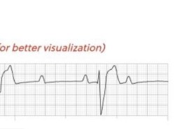 What is this rhythm?